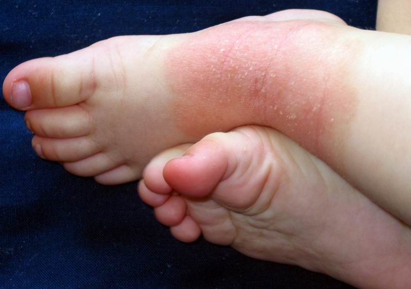 dermatitis atopica